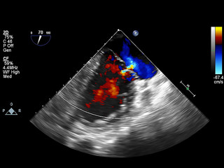 Screen of echocardiography (ultrasound) machine.