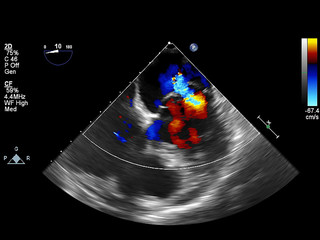 Screen of echocardiography (ultrasound) machine.