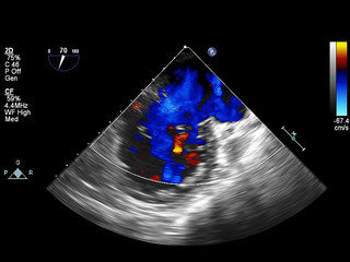 Screen of echocardiography (ultrasound) machine.