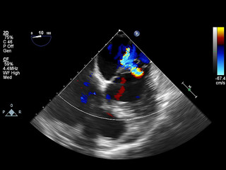 Screen of echocardiography (ultrasound) machine.