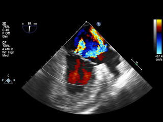 Screen of echocardiography (ultrasound) machine.