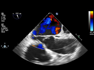 Screen of echocardiography (ultrasound) machine.