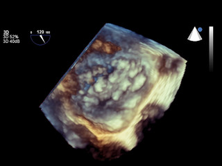 Modern 3D echocardiography.