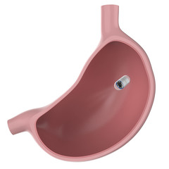 capsule endoscopy in stomach