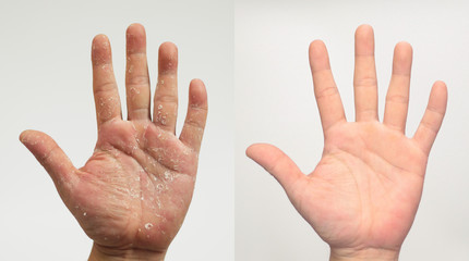Before and after the treatment of skin diseases. Psoriasis on the palm. Compare.
