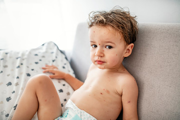 Closeup of cute little boy. Varicella virus or Chickenpox bubble rash on child. Concept quarantine...