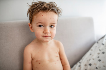 Closeup of cute little boy. Varicella virus or Chickenpox bubble rash on child. Concept quarantine in kindergarten. Portrait of sick little boy. Young toddler with chickenpox