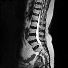 MRI L-s spine or MRI of lambosacral spine or L-S spine on sagittal plane T2 technique for diagnosis spinal cord compression. - obrazy, fototapety, plakaty