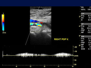 Ultrasound doppler of popliteal vien for finding  deep vein thrombosis or DVT.