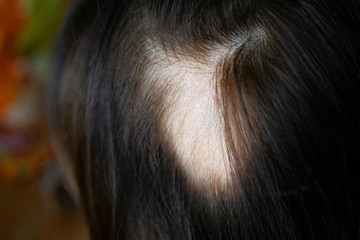 Woman hair loss. Head of woman on part of skin of which there is no hair. Maybe this is alopecia areata, lichen, trichopetia, microsporia. - 289857377