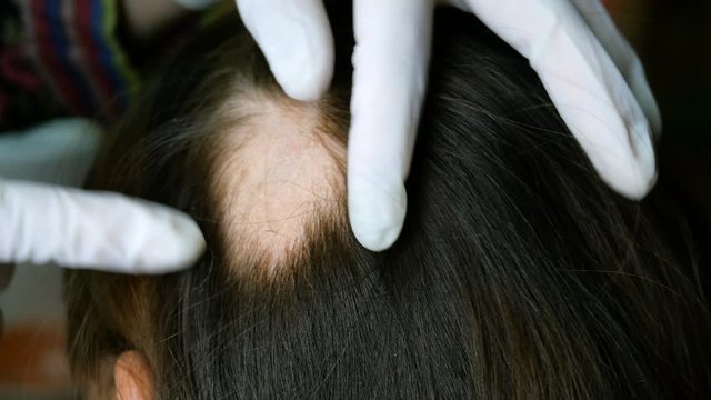 Woman hair loss. Head of woman on part of skin of which there is no hair. Maybe this is alopecia areata, lichen, trichopetia, microsporia. Close-up