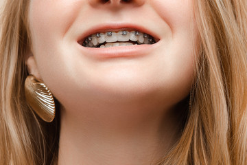 Extreme close-up teenager woman smiling with open mouth showing braces on teeth. Face of European...