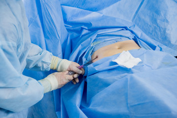 Arthroscope surgery. Orthopedic surgeons in teamwork in the operating room with modern arthroscopic tools.