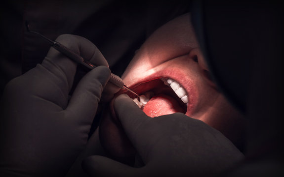 tdentistry. dental treatment, close-up. teeth and caries.