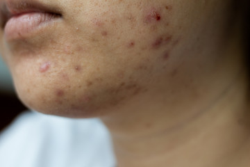 Close-up facial skin is acne and scar.