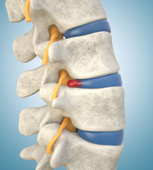 Human lumbar spine model with herniated disc