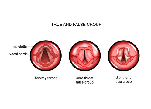 diphtheria. true and false croup
