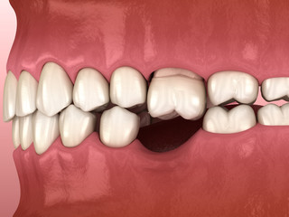 Teeth shift deformatiuon after losing molar tooth. 3D illustration of Popov Godon phenomenon