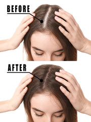 Woman before and after hair loss treatment on white background - obrazy, fototapety, plakaty