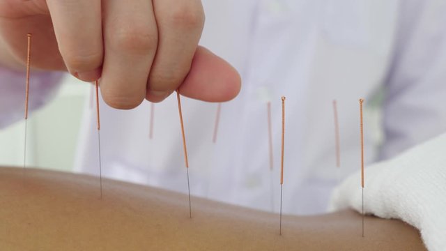 Closeup of acupuncturist hand inserting needle at patient back