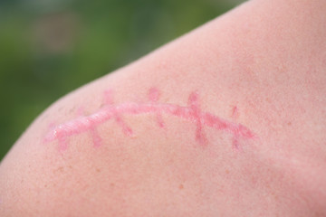 Fototapeta premium Scar. Skin wound. Plastic surgery. Scarification. White skin with a pink surgical scar on shoulder. Female shoulder and laser scar removal treatment.