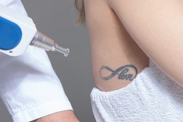  laser tattoo removal  in clinic closeup - 290206900