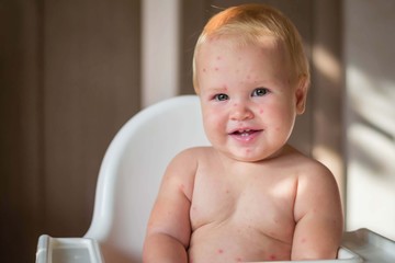 The child is sick with varicella. Measles. The child sits in a feeding chair and eats a banana.  