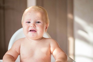 The child is sick with varicella. Measles. The child sits in a feeding chair and eats a banana.  