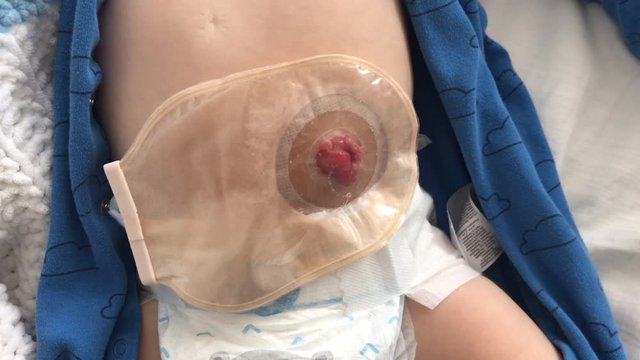 Close-up top view on transparent colostomy pouch attached to baby patient. Ostomy bag with filter. Colostomy surgery.