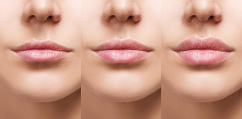 Lips of young woman before and after augmentation. - 290255599