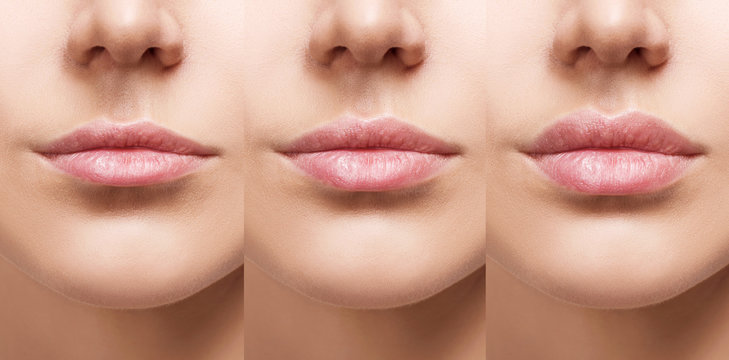 Lips of young woman before and after augmentation.