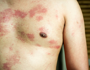 Fototapeta premium Ringworm on the body, skin infection that’s caused by mold.