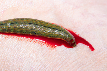 Aquatic Leech sucking blood on skin,Leeches were used in medicine from ancient