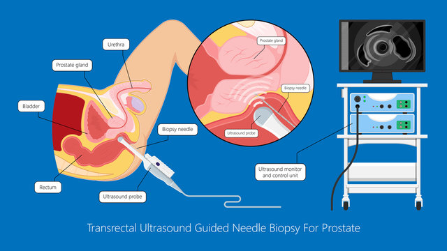 Transurethral resection of the prostate stricture urine bladder digital rectal exam specific antigen Gleason score biopsies Prostatitis test blood ultrasonography Radical Prostatectomy