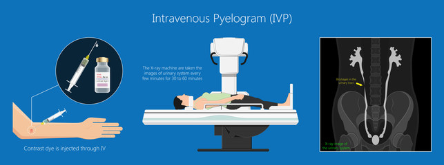 Intravenous pyelogram IVP examination x-ray for bladder kidney ureters disease problem - obrazy, fototapety, plakaty