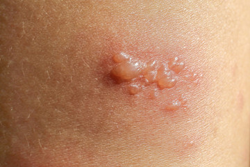 skin rash as allergic symptoms due to arm fiberglass cast