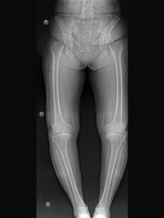 film x-ray knee radiograph showing bow leg deformity (genu varus or bowlegged) from knee arthritis disease (osteoarthritis or OA disorder) which cause knee pain and walking problem.(R = right side)