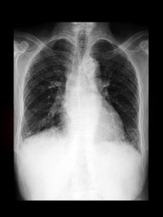 film x-ray chest radiograph (CXR) show enlargement of lung 's airways (bronchiectasis disease). medical imaging concept