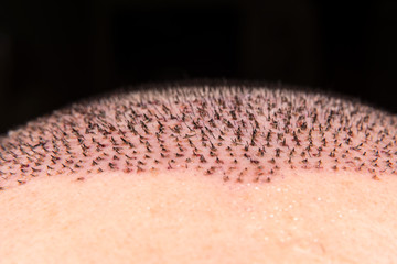 Close up hair graft transplantation with follicular unit extraction (FUE). Bald head of hair loss...