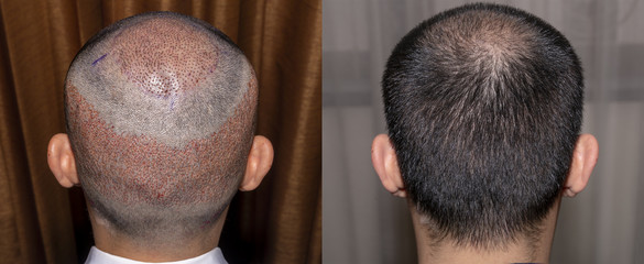 Back view of a man's head with hair transplant surgery with a receding hair line. - Before and...