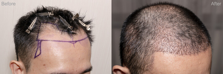 Top view of a man's head with hair transplant surgery with a receding hair line. - Before and After Bald head of hair loss treatment. - obrazy, fototapety, plakaty