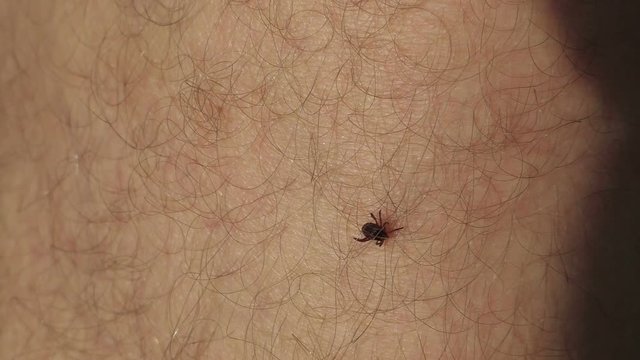  Insect parasite mite crawls on a man's leg. Tick on the skin.