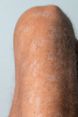Fototapeta premium Large plaque parapsoriasis on caucasian man legs