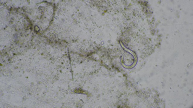 Strongyloides stercoralis larva in stool exam.Parasite in human.