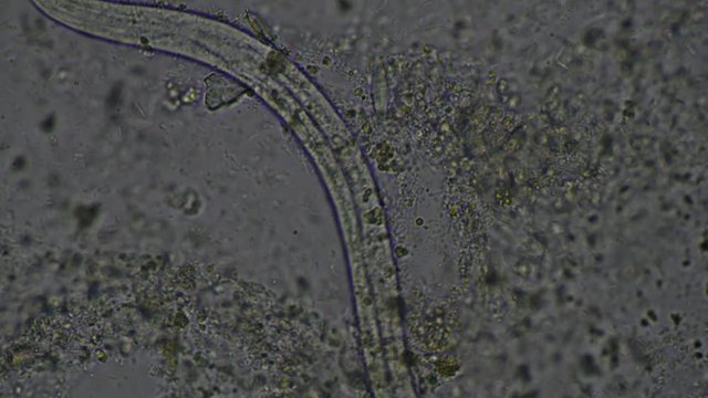 Strongyloides stercoralis larva in stool exam.Parasite in human.