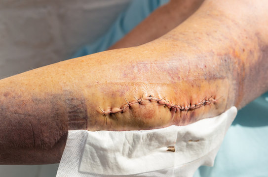 Bluterguss am ganzen Arm und ein Ellenbogenbruch 