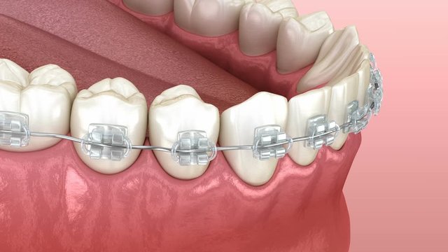 Mandibular jaw and Clear braces. Medically accurate dental 3D animation