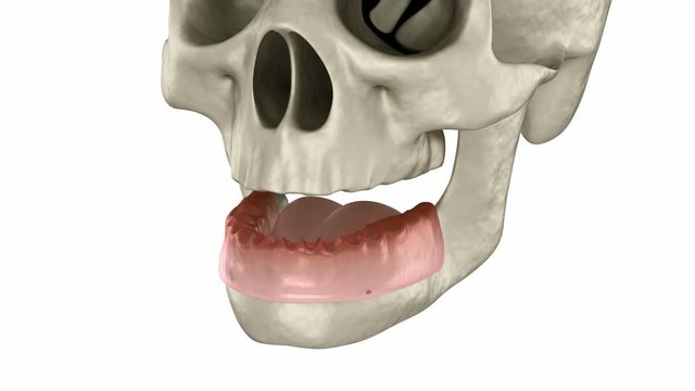 Mandibular prosthesis All on 4 system supported by implants, screw fixation. Medically accurate 3D animation of dental concept