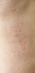 Fototapeta premium Skin imperfection. Skin allergy. Urticaria disease. Red spots on the skin.