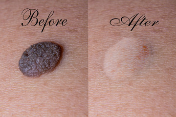 Mole removal inborn  Brown background